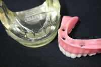 取り外し式の入れ歯