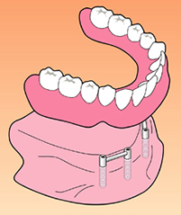 ドルダーバー義歯
